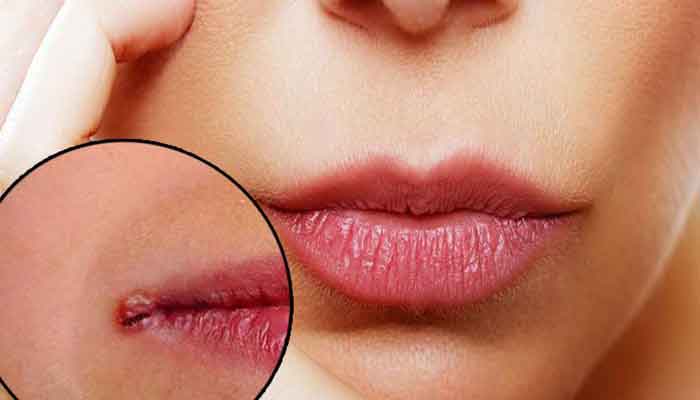 راهکارهای درمان ترک های گوشه لب